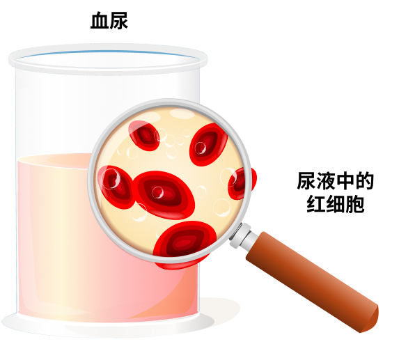 What is Haematuria?