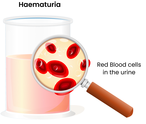 What is Haematuria?