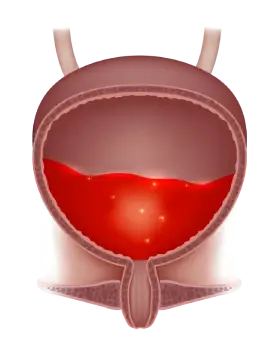 What Could’ve Caused Blood in the Urine?