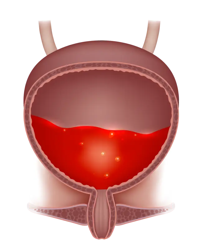 What Could’ve Caused Blood in the Urine?